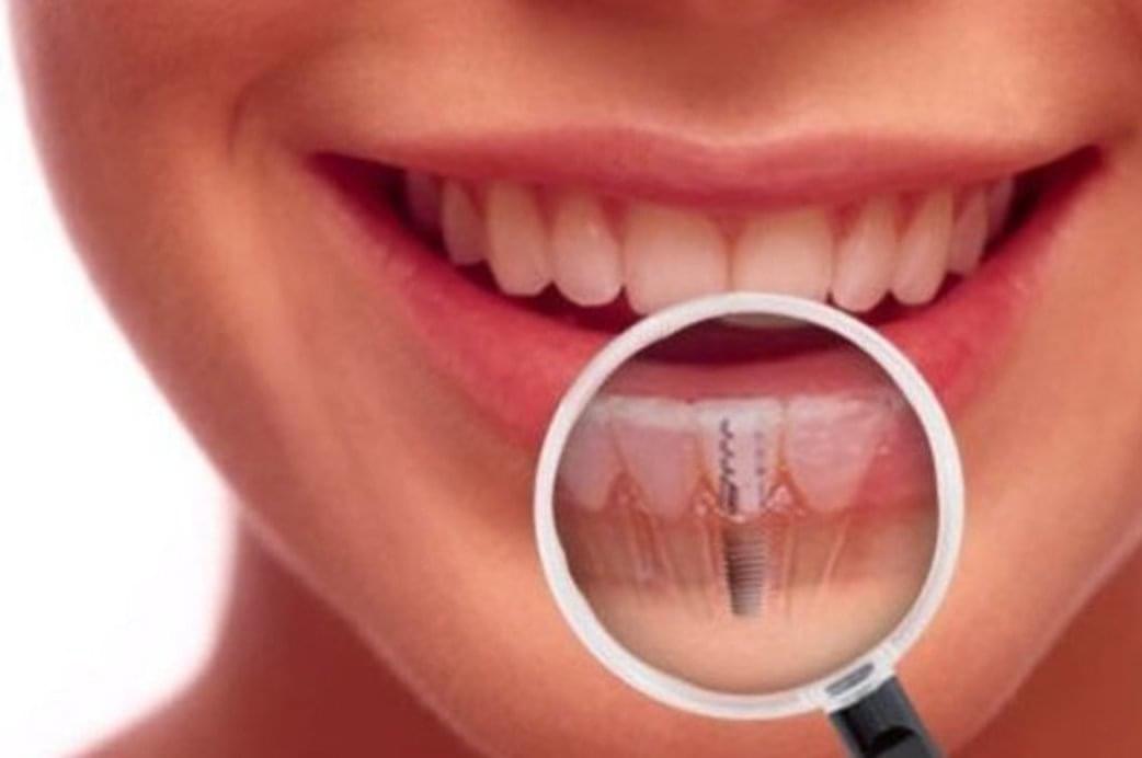 Dental Implants